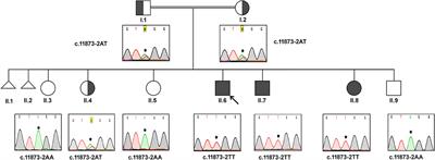 Identification of a Rare Exon 19 Skipping Mutation in ALMS1 Gene in Alström Syndrome Patients From Two Unrelated Saudi Families